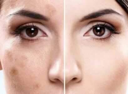 how to remove pigmentation from face home remedies