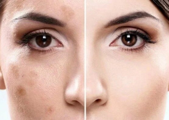how to remove pigmentation from face home remedies