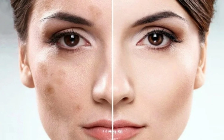 how to remove pigmentation from face home remedies