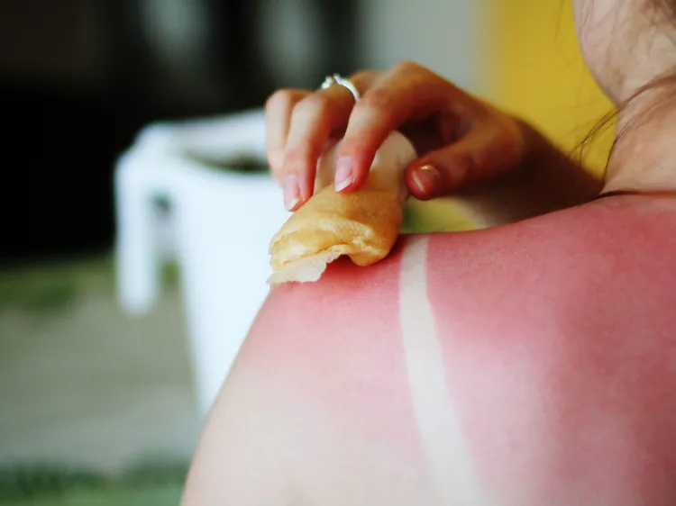 black skin do get sunburned it is best to take advantage of the natural methods available that can truly help you to eliminate the initial signs of sunburns