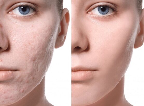 how to remove acne scars naturally in a week