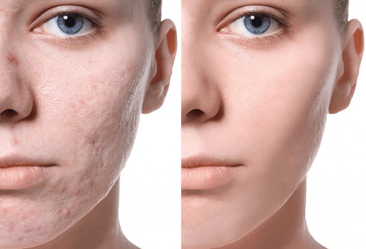 how-to-remove-acne-scars-naturally-in-a-week-find-out-now