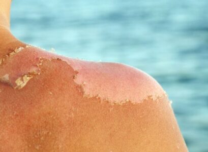sun burn on black skin you are probably aware that a sunburn is a painful and annoying problem that is caused by being exposed to the sun for hours