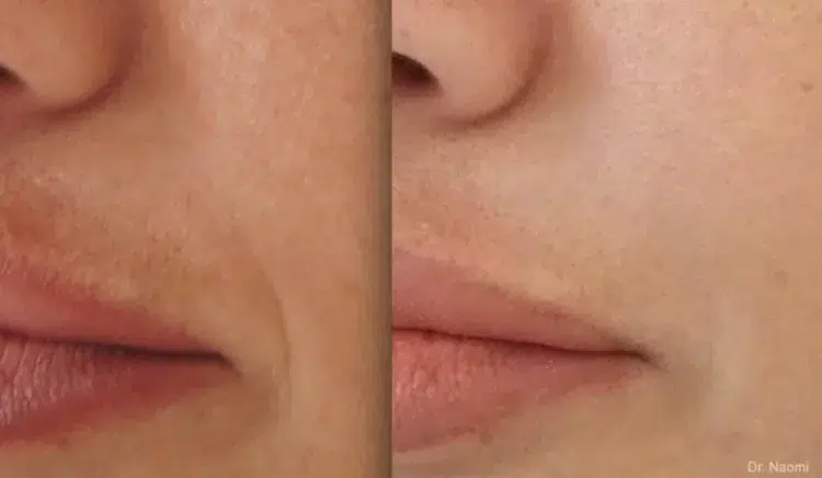 how do i get rid of hyperpigmentation on my mustache