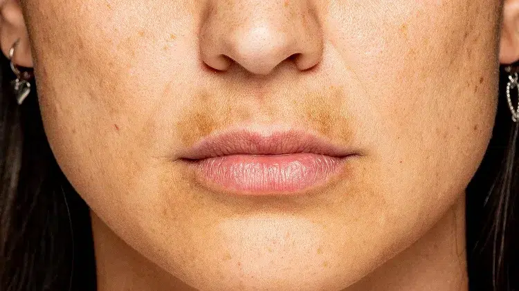 how to get rid of melasma mustache hyperpigmentation on the upper lip