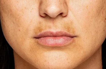 how to get rid of melasma mustache what is a sun moustache