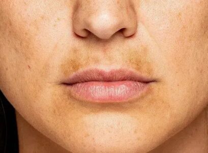 how to get rid of melasma mustache what is a sun moustache