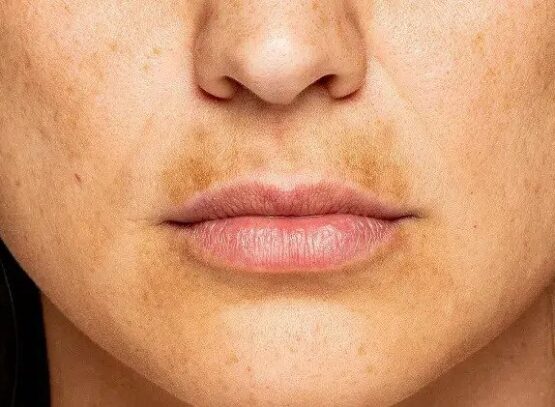 how to get rid of melasma mustache what is a sun moustache