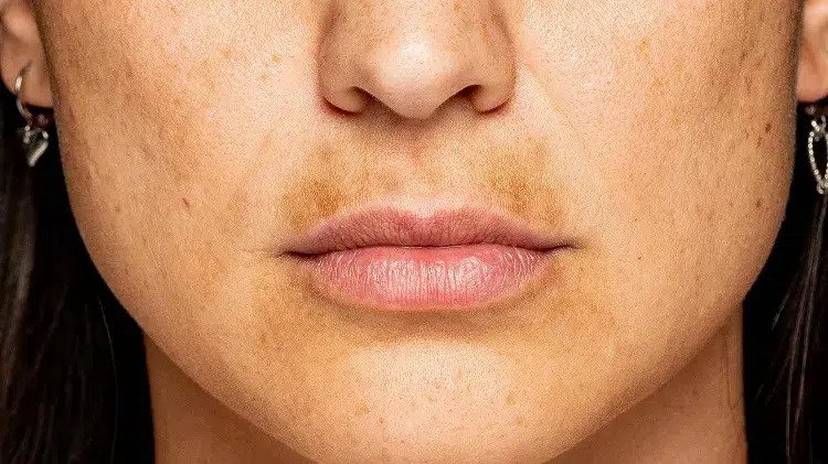 how to get rid of melasma mustache what is a sun moustache