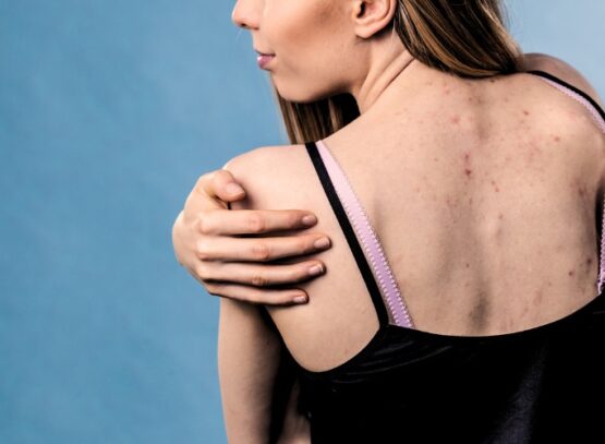 how to prevent body acne bacne treatment remedies tips tricks