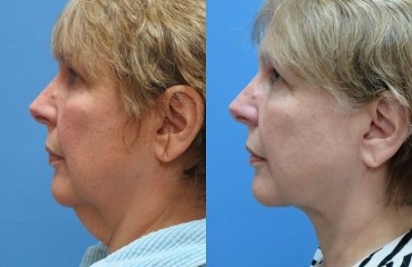 tigthen saggy neck without surgery before and after