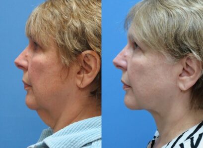 tigthen saggy neck without surgery before and after