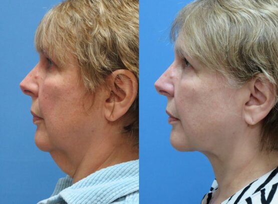 tigthen saggy neck without surgery before and after