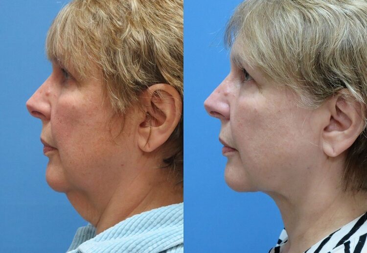 tigthen saggy neck without surgery before and after