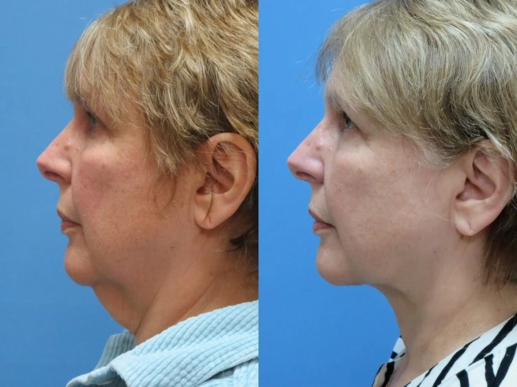 tigthen saggy neck without surgery before and after
