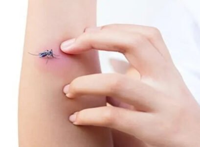 how to soothe mosquito bites what home remedies can you use immediately