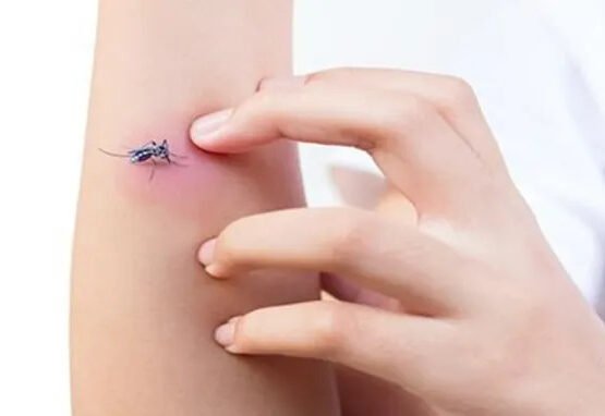 how to soothe mosquito bites what home remedies can you use immediately