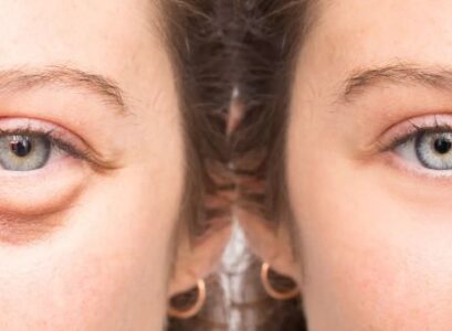 best under eye patches for puffiness and dark circles
