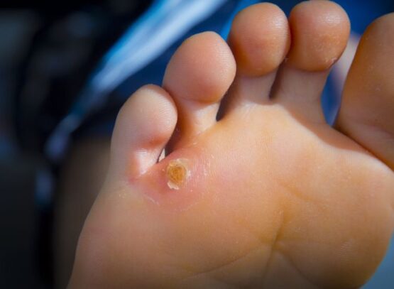 how to get rid of calluses at home