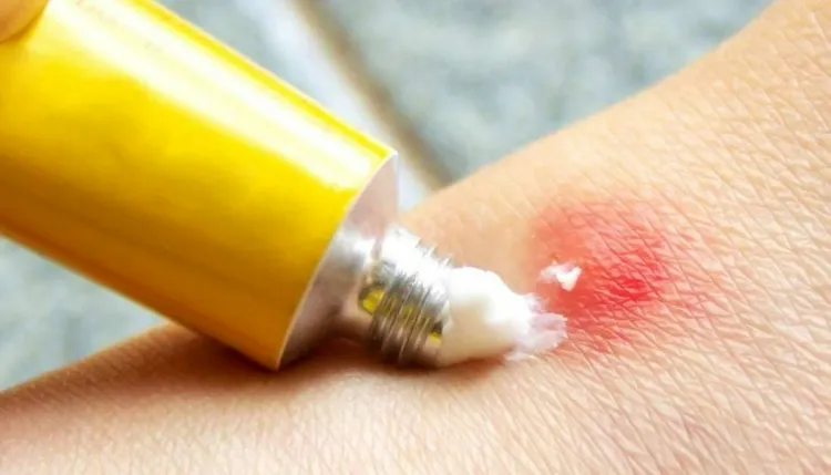 how to relieve mosquito bites reduce inflammation apply cream