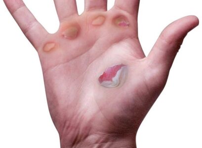 how to treat blisters on hands leave them to cure on air or covering method