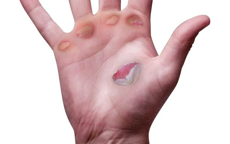 how to treat blisters on hands leave them to cure on air or covering method