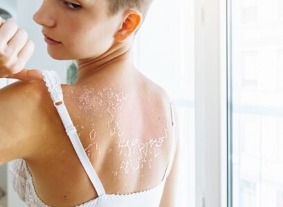 damaged peeling back skin sunburn blisters causes treatment