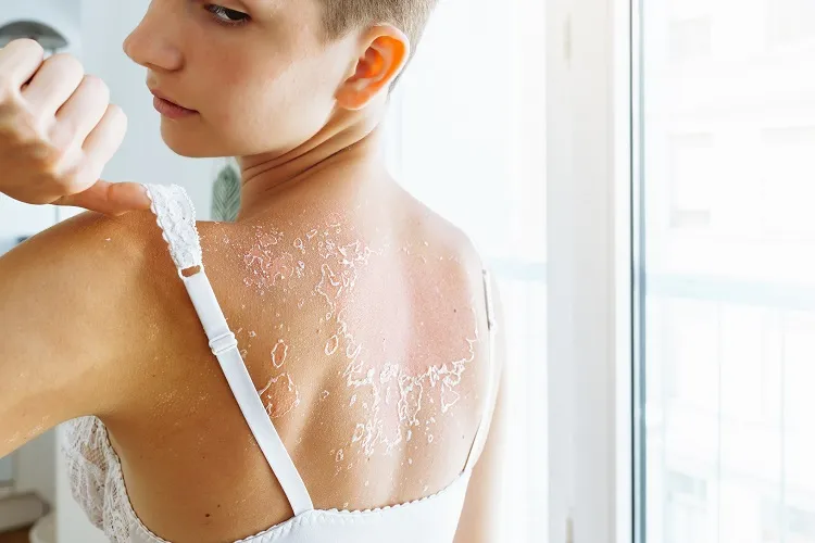 damaged peeling back skin sunburn blisters causes treatment