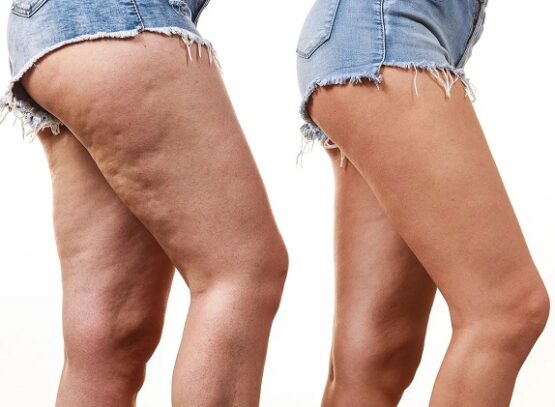 get rid of cellulite on thighs get rid of cellulite on thighs naturally and effective