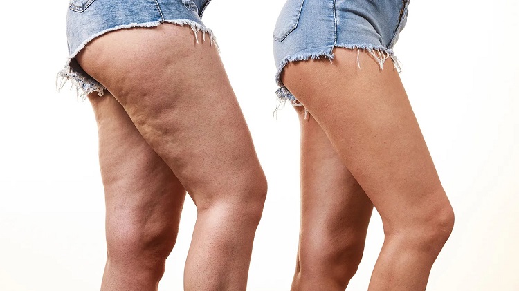 get rid of cellulite on thighs get rid of cellulite on thighs naturally and effective