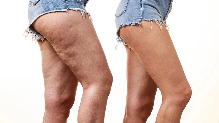 how do you get rid of cellulite on your thighs get rid of cellulite on thighs naturally and effective