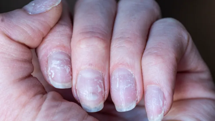 peeling or discolored nails