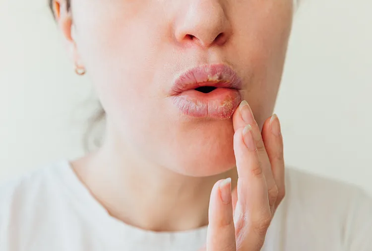 swollen lips nail polish allergy