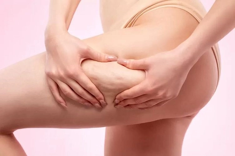 what causes cellulite on thighs factors and causes of cellulite