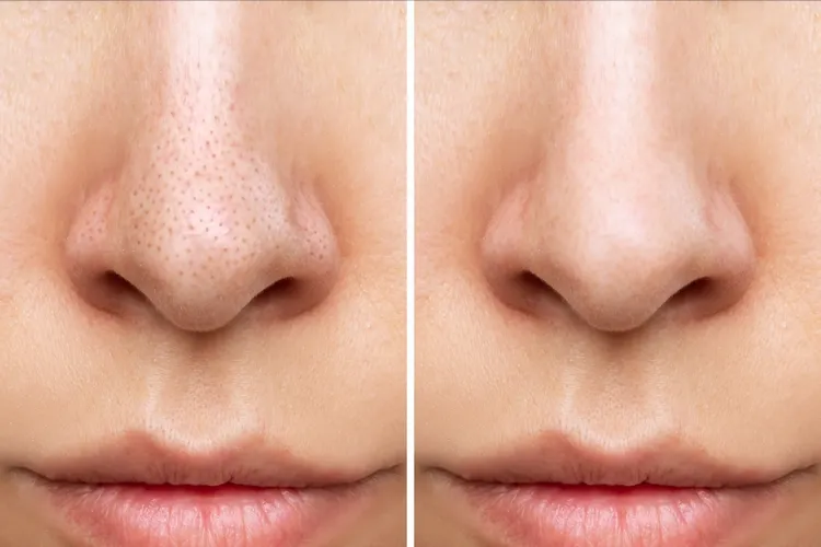 before after removing blackheads