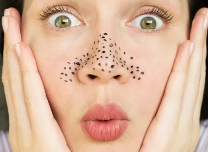 can you remove blackheads with toothpaste does this method really work