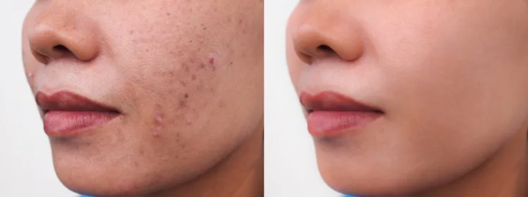 acne before after sea moss face mask