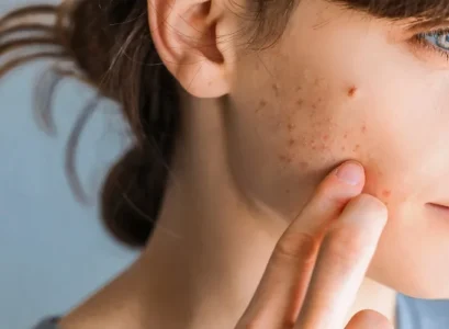 adult acne skin care routine
