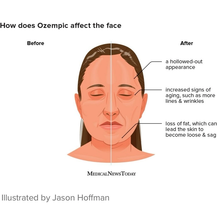 how to identify that you have an ozempic face